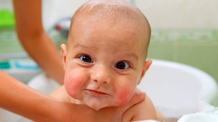 як уникнути сухості шкіри у немовляти