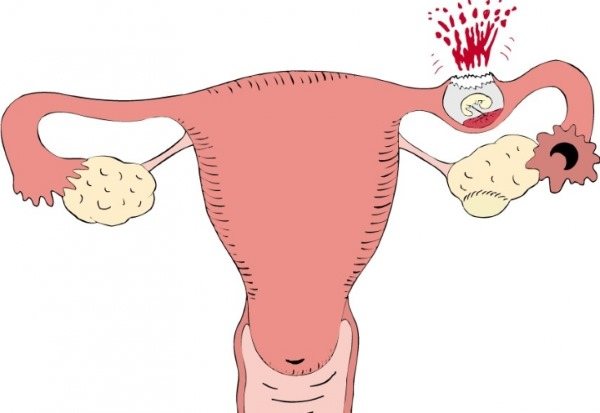 Як відрізнити місячні від кровотечі при клімаксі, викидні, позаматкової вагітності, після пологів, кесаревого розтину, припікання ерозії