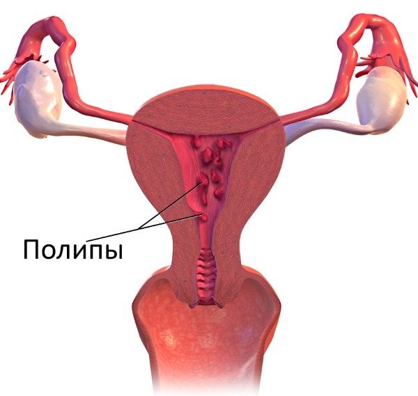 Як відрізнити місячні від кровотечі при клімаксі, викидні, позаматкової вагітності, після пологів, кесаревого розтину, припікання ерозії