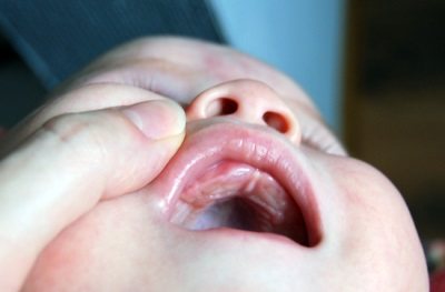 Як Виглядає прорізування зубів у немовлят