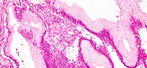 кісти підшлункової залози - вид під мікроскопом