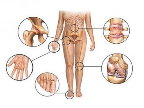 Класифікація ревматоїдного артриту ураження суглобів Діагностика та класифікація артритів