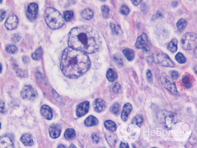 Клітини Рід - Штернберга - діагностична ознака лімфоми Ходжкіна