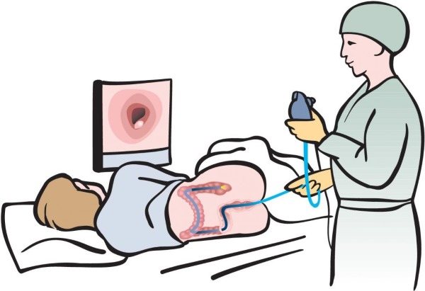 Колоноскопія кишечника. Що це, показання до обстеження, як робиться, підготовка до процедури