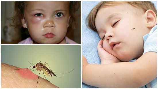 Комар на обличчі дитини