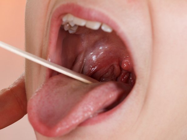 Коричневий наліт на язиці у дитини