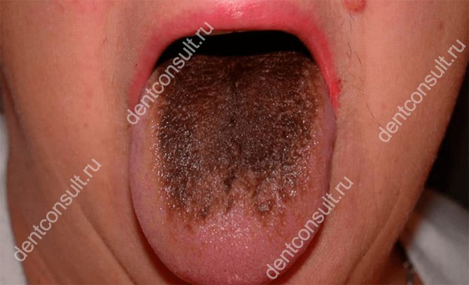 Коричневий наліт на язиці