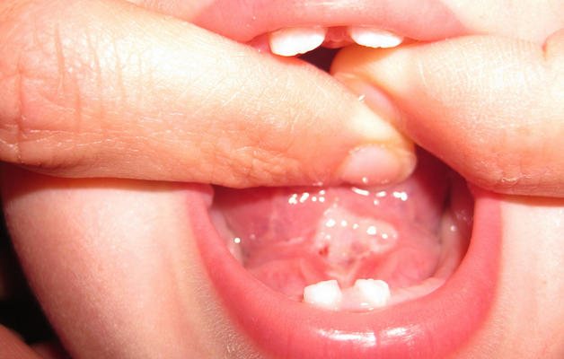коротка вуздечка язику у дитини