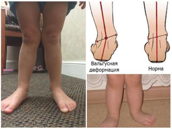 Кріві ноги у дитини