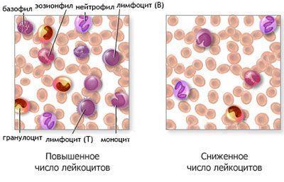 Кров при агранулоцитозе