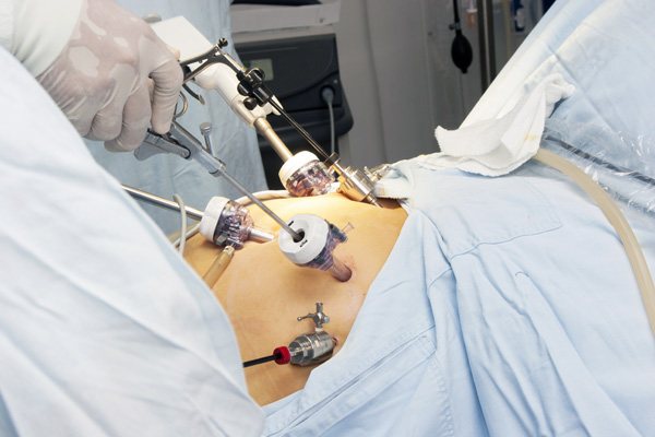 Лапароскопічна операція при аденомиозе