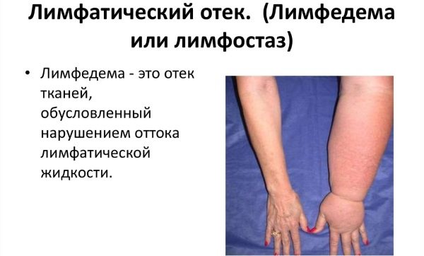Лікування лімфостазу нижніх кінцівок в домашніх умовах народними засобами, медикаментозно, вправами, масажем, дієтою