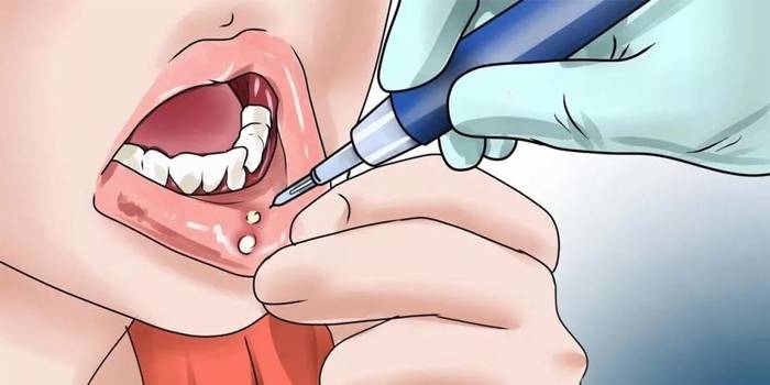 Лікування у стоматолога