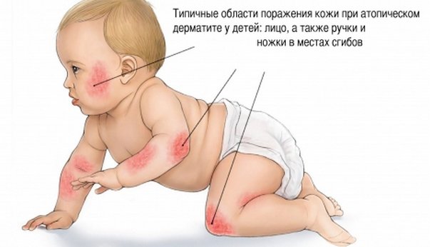 Місця можливо появи атопічного дерматиту у дитини.