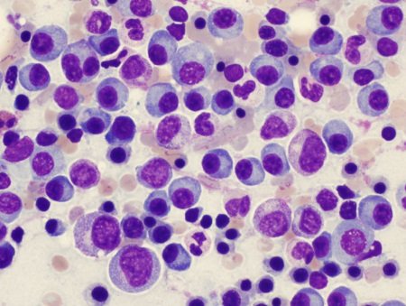 Мієломна хвороба (парапротеїнемічний гемобластози) - мазок крові