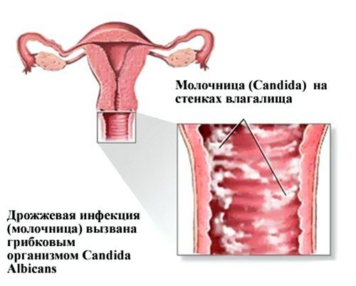 Молочниця у жінок