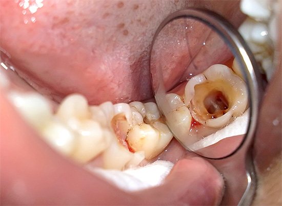 На фотографії видно кореневі канали зуба - після зачистки вони будуть запломбовані.