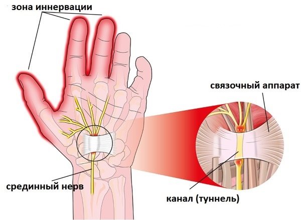 Німіють пальці рук: причина і лікування: великий, мізинець, безіменний, вказівний на лівій і правій руці. З яким захворюванням пов'язано