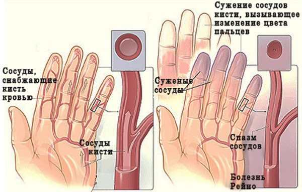 Німіють пальці рук: причина і лікування: великий, мізинець, безіменний, вказівний на лівій і правій руці. З яким захворюванням пов'язано