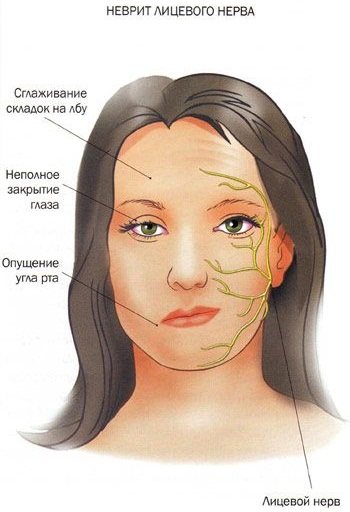 Невралгія лицьового нерва. Симптоми і лікування, народні засоби, препарати