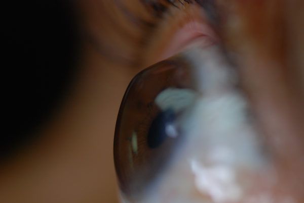 Незначні Зміни очі при початкових формах захворювання
