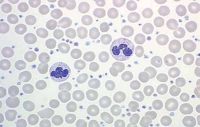 Низькі Клітини тромбоцітів