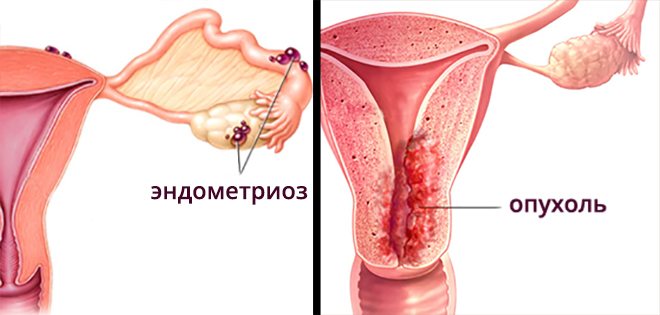 низький прогестерон симптоми у жінок лікування