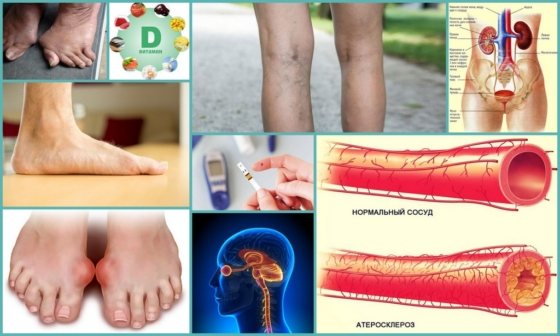 Нічні судоми ніг причини, лікування і профілактика захворювання