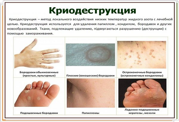Новоутворення на шкірі: фото і опис на голові, руках, обличчі та тілі. Як лікувати доброякісні та злоякісні новоутворення