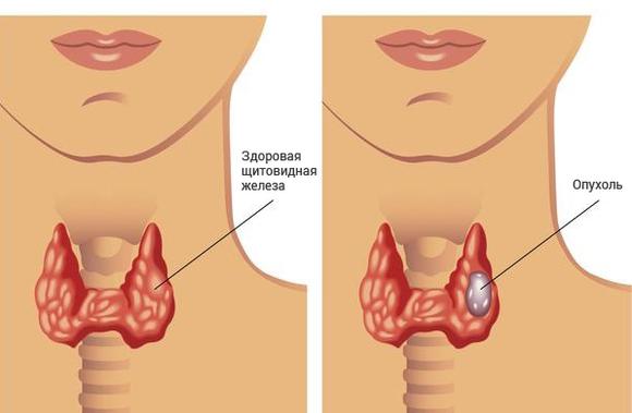 утворення лівої частки щитовидної залози