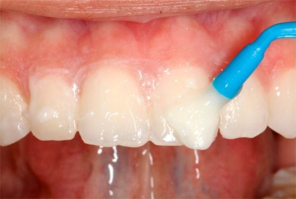 Особливості реминерализации зубів при флюорозе