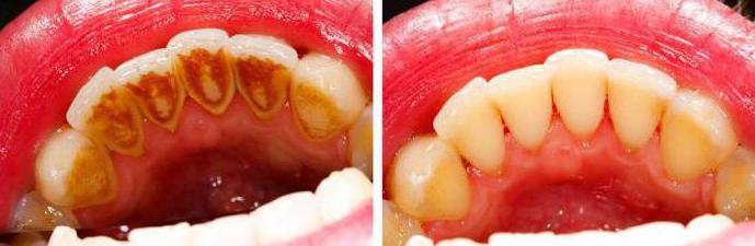 від чого з'являється зубний камінь причини оброзованія