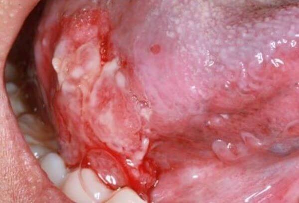 Від чого залежить ефективність лікування раку порожнини рота
