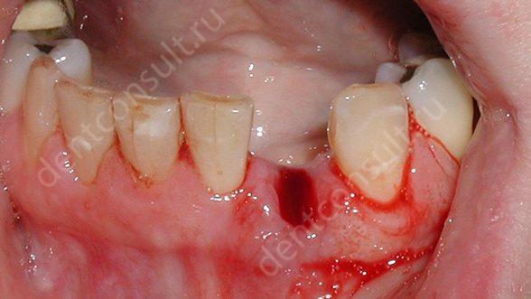 Набряк після видалення зуба