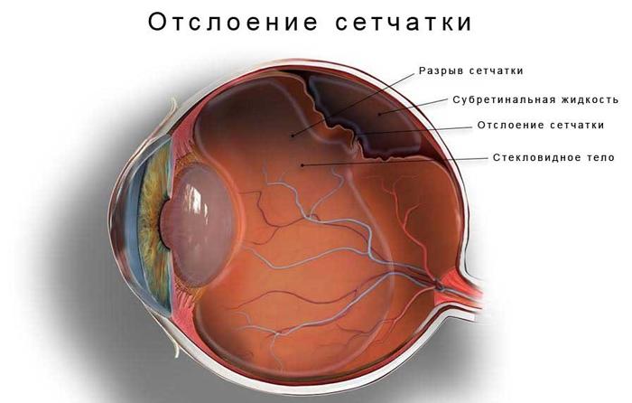 відшарування сітківки ока