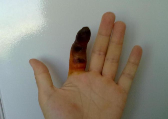 Пандактиліт - можливе ускладнення абсесса на пальці.
