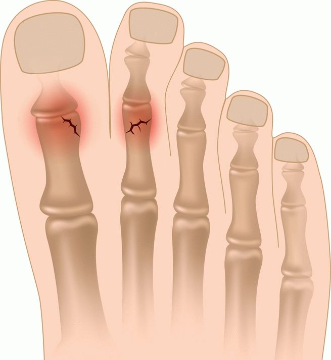 перелом пальця ноги