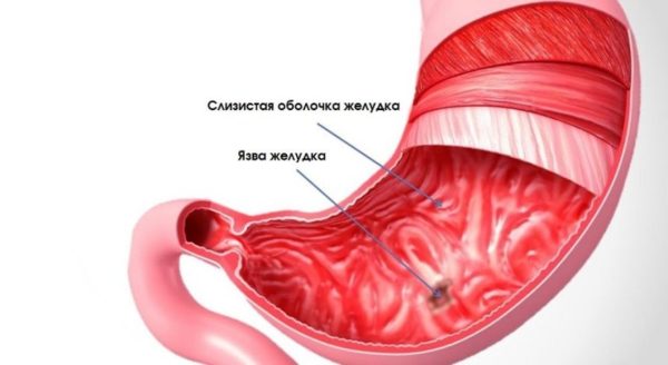 Перфорація виразки шлунка і дванадцятипалої кишки