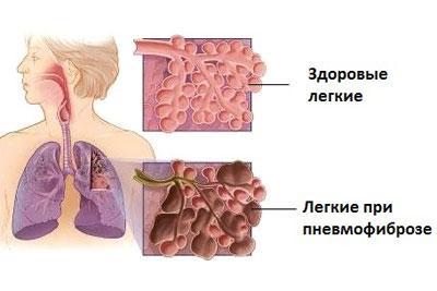 пневмофіброз легких