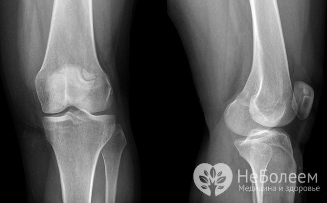 Підтвердити діагноз бурситу дозволяє рентгенографічне дослідження колінного суглоба