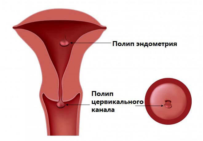 поліпозні вузли ендометрія