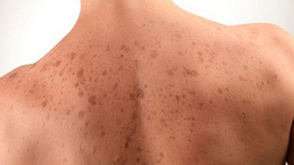 З'явилися темні плям