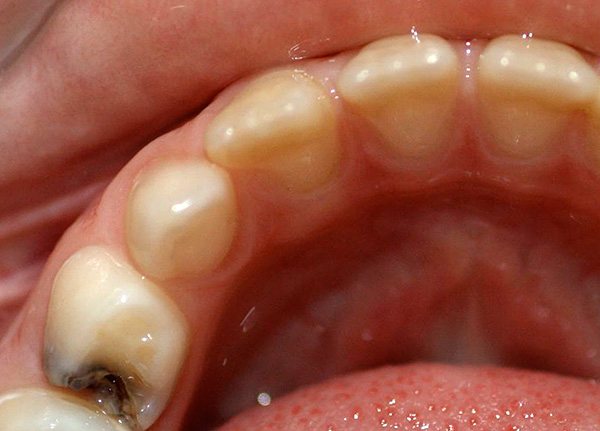 При гострого болю в зубі доцільно негайно звернутися за екстреною стоматологічною допомогою.