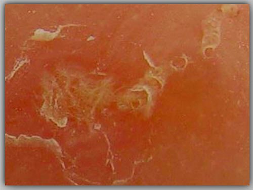 Причини хвороби: ходи самки кліща в епідермісі кожи під мікроскопом