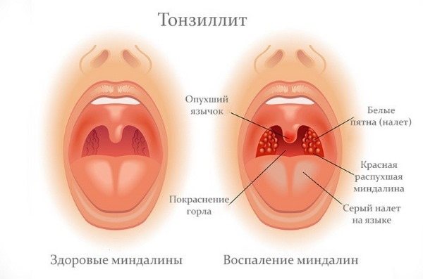 Причини крови з носа у дорослих: вранці, при нормальному стані, часто або Раптовий.  Перша допомога и лікування патології