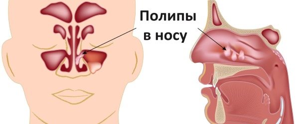 Причини крови з носа у дорослих: вранці, при нормальному стані, часто або Раптовий.  Перша допомога и лікування патології