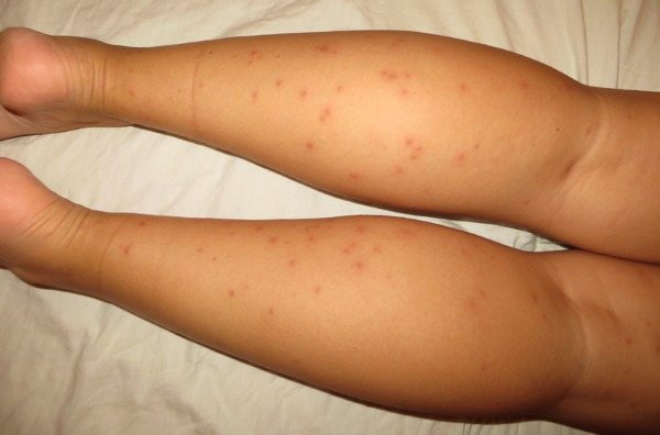 Причини свербіння, якщо свербить тіло: червоні, рожеві плями, пухирі, висип як комарині укуси. Фото з поясненнями