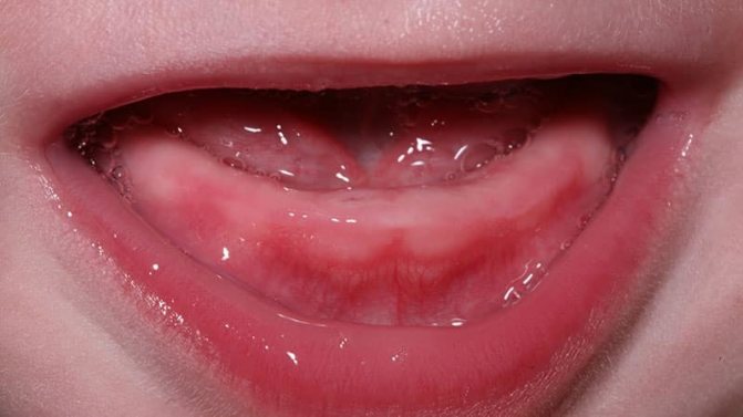 Пріпухлість и набряклість ясен - ознака прорізування зубів у дітей.