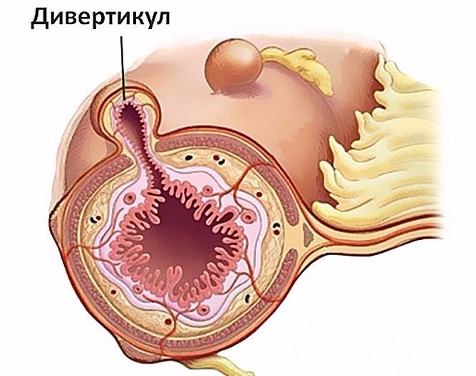 Ознаки дивертикулеза кишечника