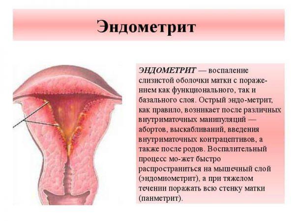 Ознака ендометриту